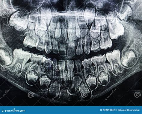 Dental X-Ray of Child 6 Years, All Baby Teeth in View. Stock Photo - Image of medical, female ...