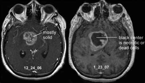 Progression in 1 month of untreated GBM. | Download Scientific Diagram