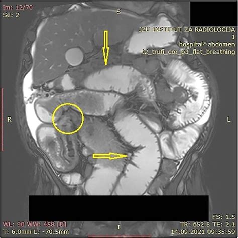 MR enterography with dilated small bowel loops (arrows) and visible ...