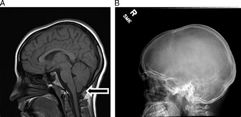 Chiari Malformation in the Concussion Clinic: Diagnosis and... : American Journal of Physical ...