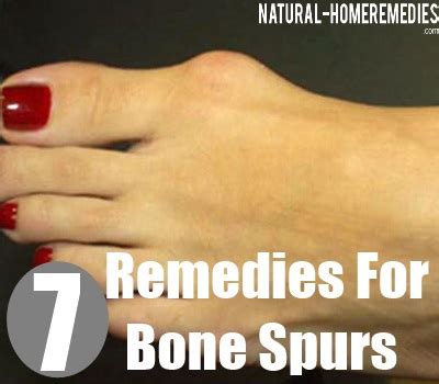 Top 7 Home Remedies For Bone Spurs - Natural Treatments And Cures For Bone Spurs | Natural Home ...