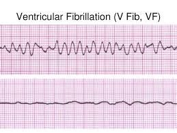 v fib ecg - Google Search | Google search, Cardiology