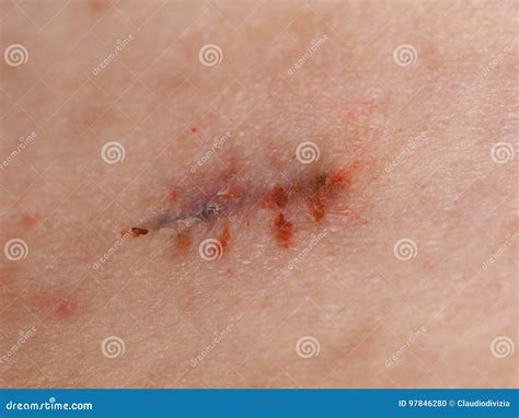 Surgical Wound Stitches Removed Stock Photo - Image of stitches, iodine ...