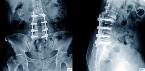 Lumbar Spinal Fusion Surgery - Brain & Spine Surgeons of New York