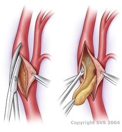 Carotid Artery Disease | Stents & Endarterectomy Surgery