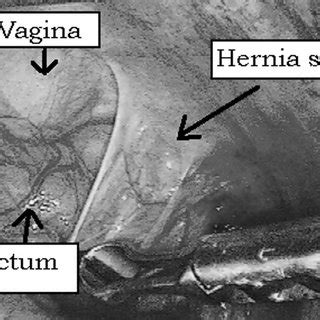 Perineal Hernia Repair After Abdominoperineal Rectal Excision | Request PDF