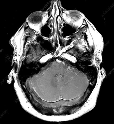 Extensive Dural Sinus Thrombosis, MRI - Stock Image - C036/5127 ...