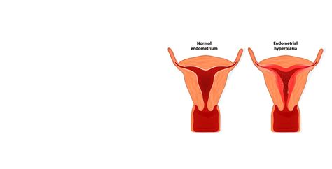 Endometrial Hyperplasia (Thick Endometrium) Causes & Treatment | Indira IVF