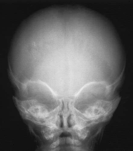 The Infant Skull: A Vault of Information | RadioGraphics