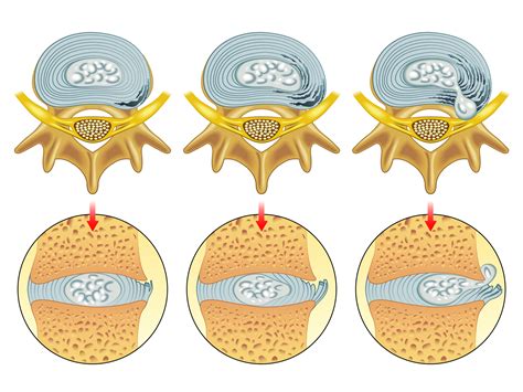 Slipped disc treatment & surgery Singapore | Slipped Disc Specialists