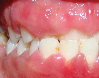 Inflamed Gums, Swollen, Infected, Bleeding, Sore, Painful, with Braces, Treatment, Home Remedy ...