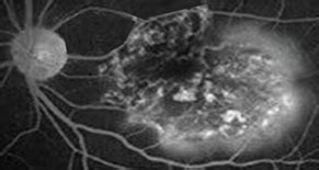 Diagnosis and management of serpiginous choroiditis - MedCrave online