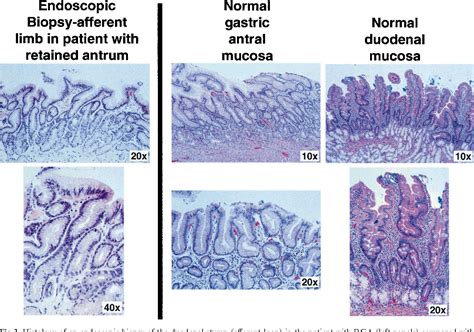 CASE REPORT: Retained Gastric Antrum Syndrome | Semantic Scholar