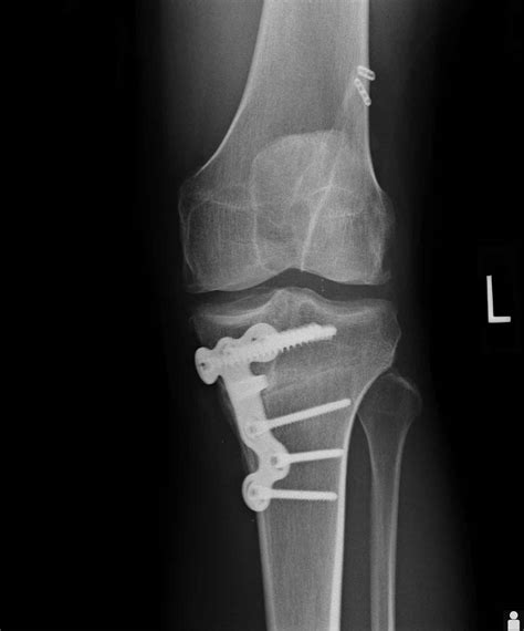 Knee Osteotomy | Knee Surgeon | Santa Barbara, Santa Maria, Ventura CA