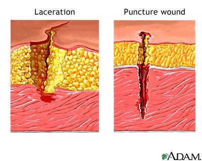 Lacerations Wound Treatment & Types