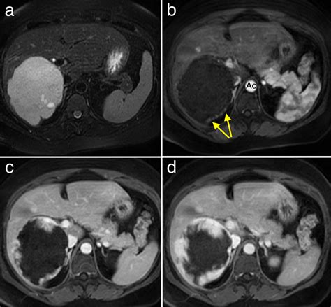 Haemangioma of liver - MRI - Radiology at St. Vincent's University Hospital