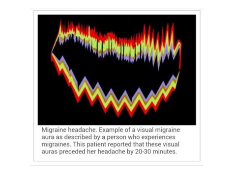 Migraine