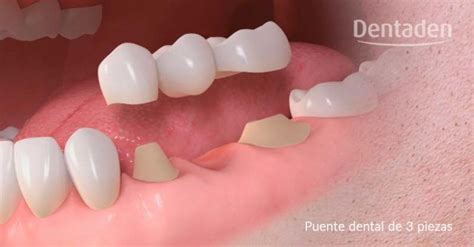 ¿Qué es y en que consiste un puente dental? - Dentaden