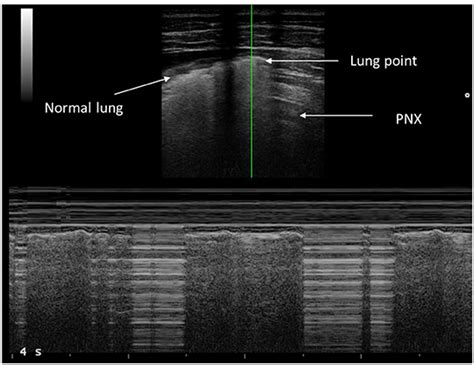 Frontiers | Lung Ultrasound to Detect Pneumothorax in Children Evaluated for Acute Chest Pain in ...