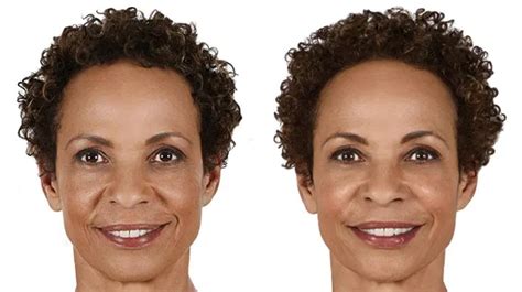 JUVÉDERM® Before & After Photos Patient 7 | Houston, TX | DermSurgery Associates