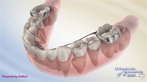 Lingual Arch - Orthodontics - YouTube