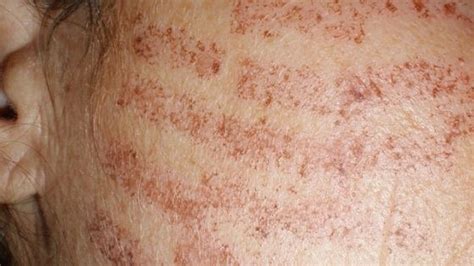 Laser hair removal burns: causes, symptom and treatment