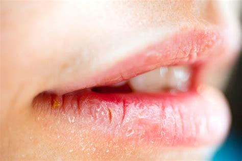 Best Home Remedies For Cracked Lips Corner Or Angular Cheilitis | Hergamut.in