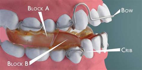 Pin by Ewa Krajewska on Ortodoncja | Orthodontics, Orthodontics marketing, Dental hygiene school