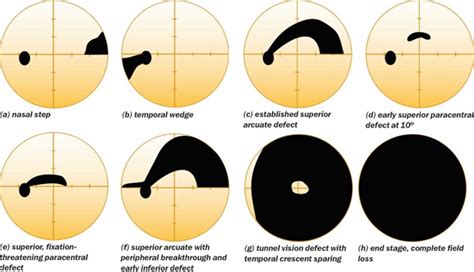 Visual field test, visual field test results interpretation