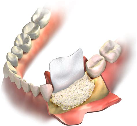 Understanding Bone Regeneration Procedures - Village Square Dental