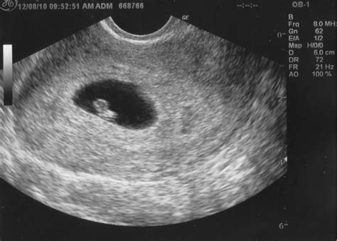 6 Weeks Pregnant: Symptoms, Ultrasound, Spotting and Cramping