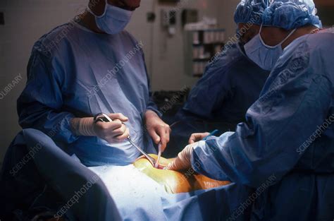 Abdominal Surgery - Stock Image - C012/3760 - Science Photo Library