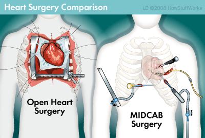 Minimally Invasive Aortic Valve Surgery | Heart Surgery Information