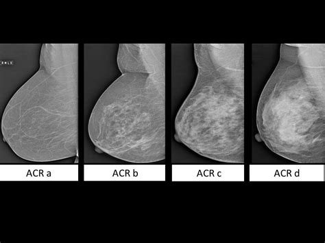 Atlas of breast cancer early detection