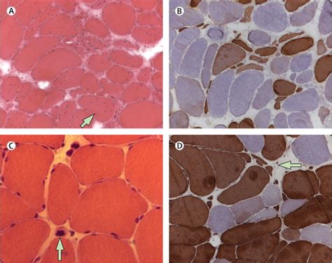 The myotonic dystrophies: molecular, clinical, and therapeutic challenges - The Lancet Neurology