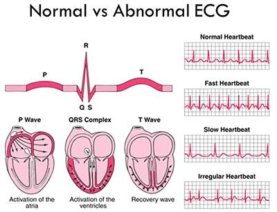 Mengenal Heart Rate, Apa itu ECG/EKG – WIA Journal