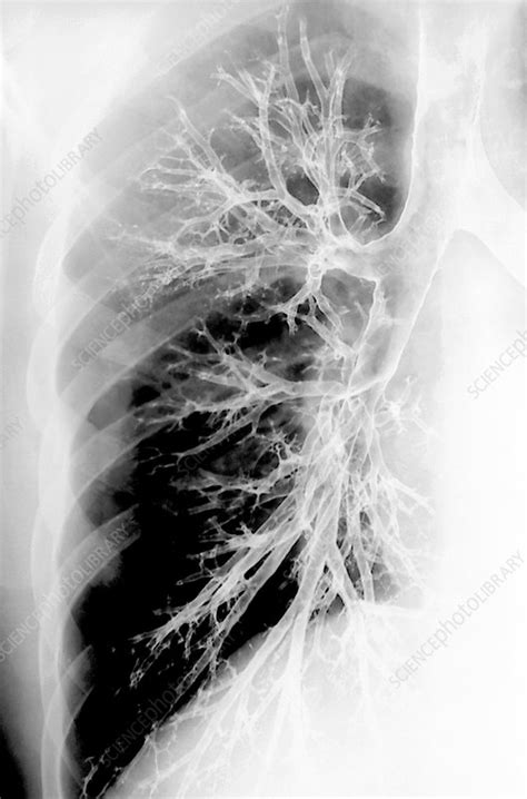 Bronchial tree of the lung, X-ray - Stock Image - C007/1628 - Science Photo Library