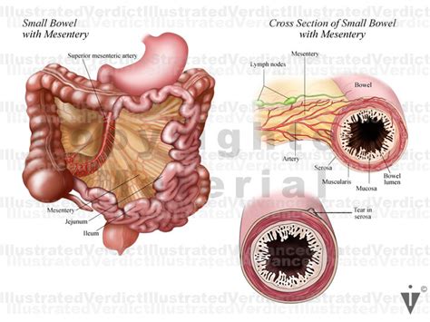 Stock Bowel: Anomalies / Obstructions / Injuries — Illustrated Verdict