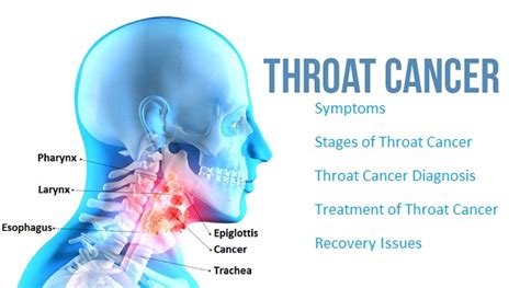 All You Need To Know About throat Cancer - VIMS