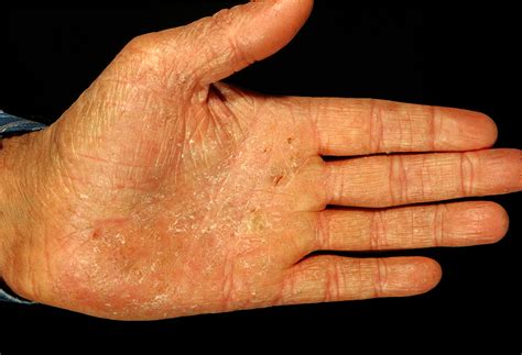 Hand eczema