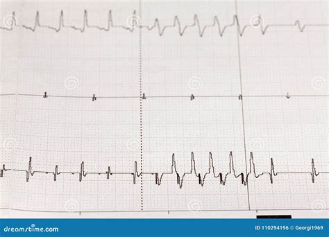 Eletrocardiograma ECG/ECG Com Arritmia Cardíaca Foto de Stock - Imagem ...