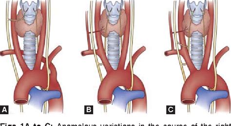 Figure 1 from Nonrecurrent Laryngeal Nerve: A Case Report and a Review of an Important ...