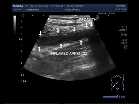 Ultrasound Video showing an inflamed appendix with a fecalith in it. - YouTube