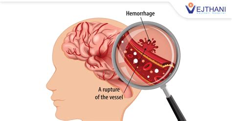 Brain Hemorrhage Epidural, Subdural, Subarachnoid,, 40% OFF