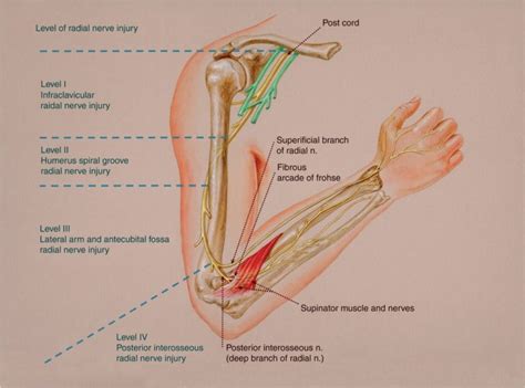 Radial Nerve Injury | Hand2Shoulder Clinic