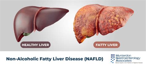 Non-Alcoholic Fatty Liver Disease (NAFLD) | Hunterdon Gastroenterology ...