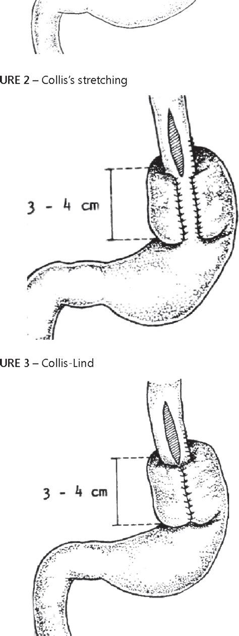 [PDF] collis gastRoplasty associated to paRcial oR total fundoplication: expeRimental study ...