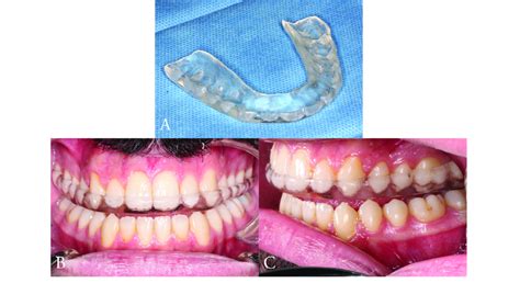 A. Michigan Splint. B. Frontal view of the Michigan Splint. C. Lateral ...