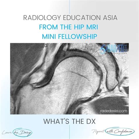 MRI HIP CAM FAI FEMORO ACETABULAR IMPINGEMENT - Radedasia