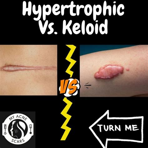 Hypertrophic Vs Keloid Scarring - My Acne Scars